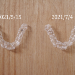 歯列矯正のリアル記録10 〜マウスピースで比較する変化